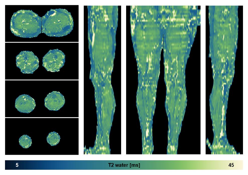 The water only T2 relaxation time of the lower extremity obtained from multi echo spin echo t2 mapping with EPG based reconstruction.